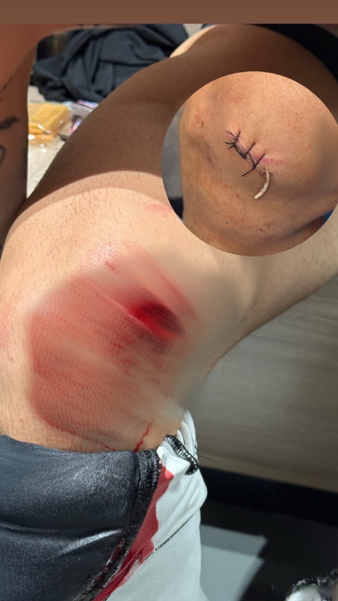 雷火电竞下载-包含感动瞬间揪心人，受伤选手坚持到最后一刻的词条